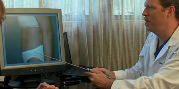 How Would You Compare Traditional Weight Loss to Liposuction?